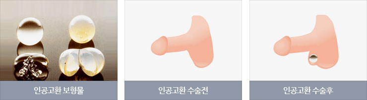 인공고환 보형물 이미지